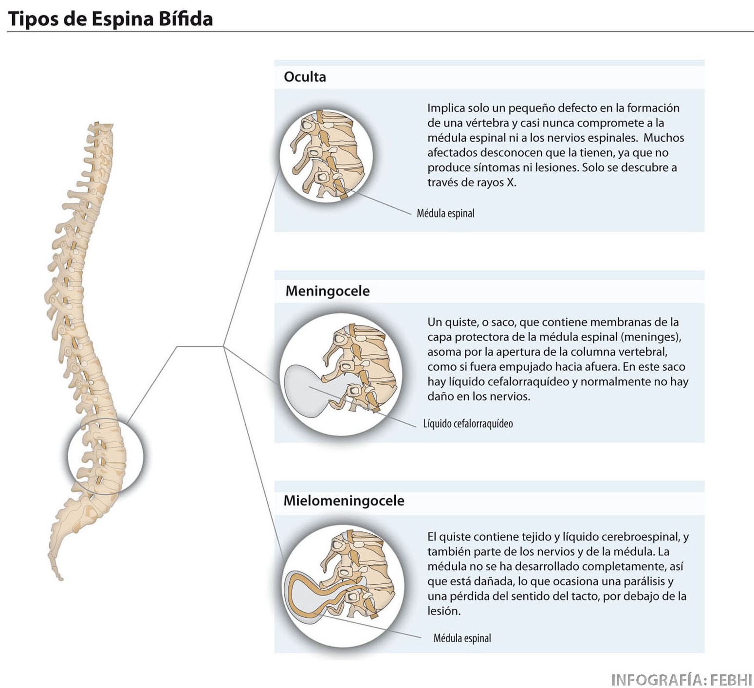 imagen representando los tipos de espina bífida